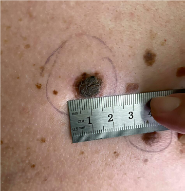mole being measured with a ruler